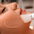 CO2 Laser vs Chemical Peel: Which Skin Resurfacing Treatment Works Better?