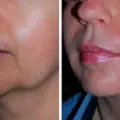 Morpheus8 Before and After: Results & Timeline | SKINnovative