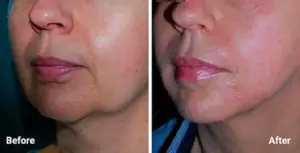 Morpheus8 results in Beverly Hills