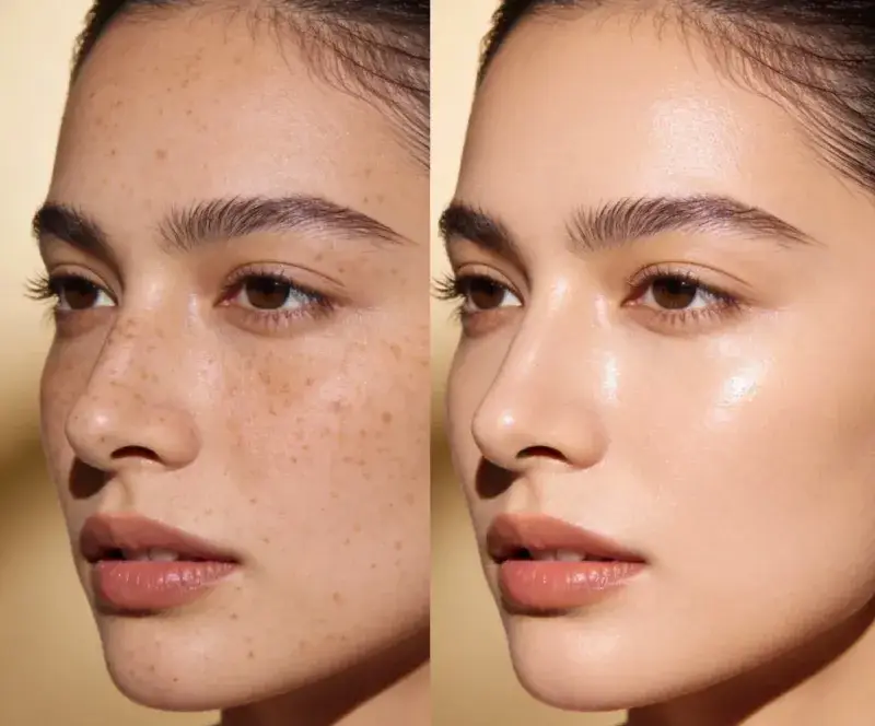 pigmentation Beverly Hills