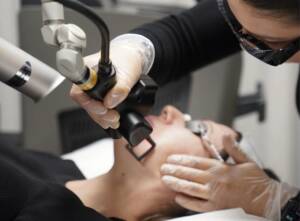 CoolPeel Laser in Beverly Hills