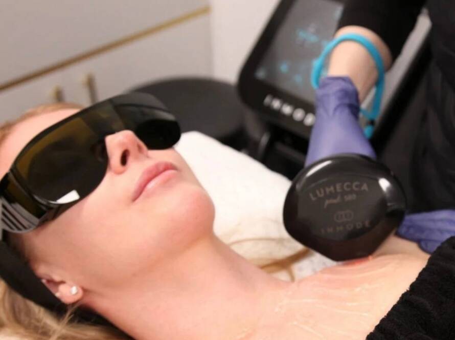 IPL Therapy in Beverly Hills