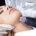 Morpheus8 in Beverly Hills | SKINnovative Medical Aesthetics