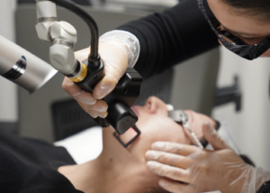 CoolPeel TetraPro CO₂ Laser in Beverly Hills