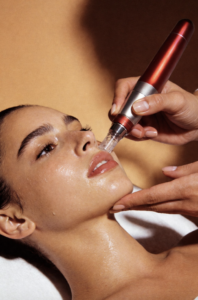 Microneedling in Beverly Hills