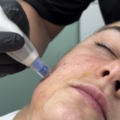 Microneedling in Beverly Hills: Everything You Need to Know Before Your First Treatment