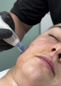 Microneedling in Beverly Hills