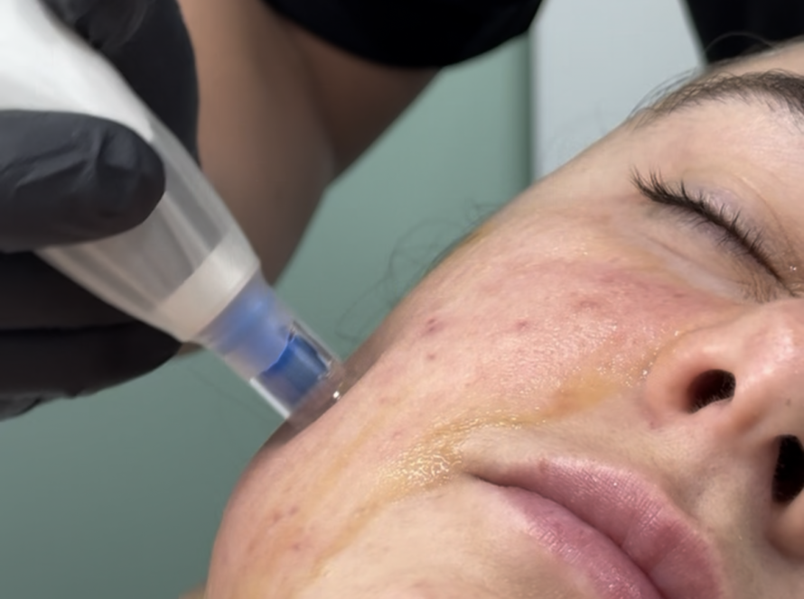 Microneedling in Beverly Hills